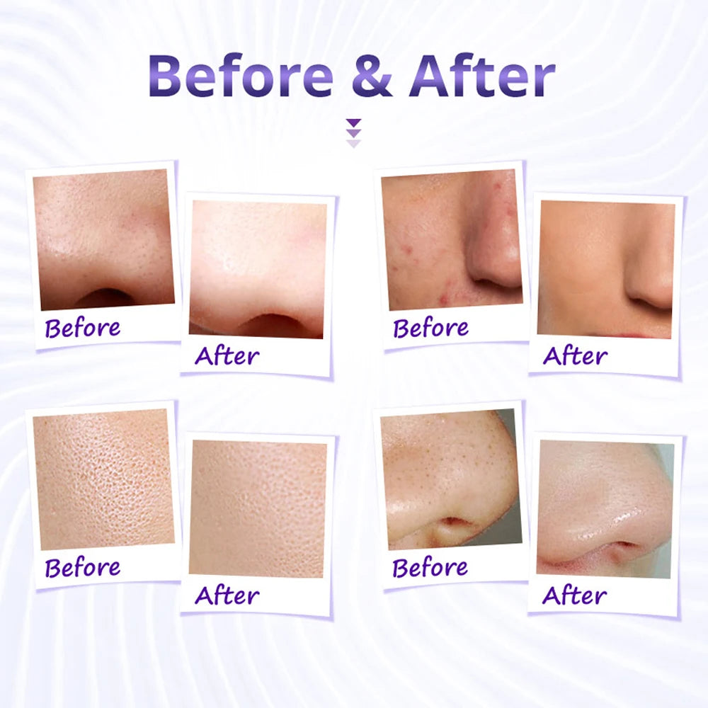Dermabrasion Microdermabrasion Machine Skin Rejuvenation Acne Remover